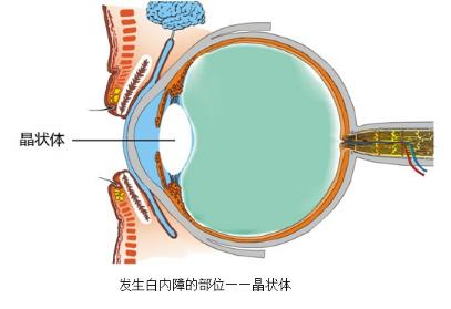 莎普爱思什么原因引起白内障