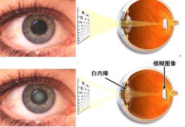 白内障怎么治效果好