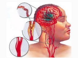 脑溢血的原因